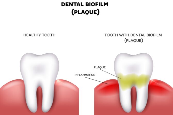 Tartrul dentar – de ce este periculos si de ce trebuie sa il indepartam?