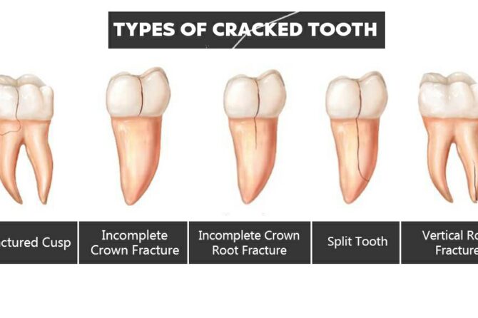 Fractura dentara: dinte rupt sau crapat. Cauze si metode de tratament