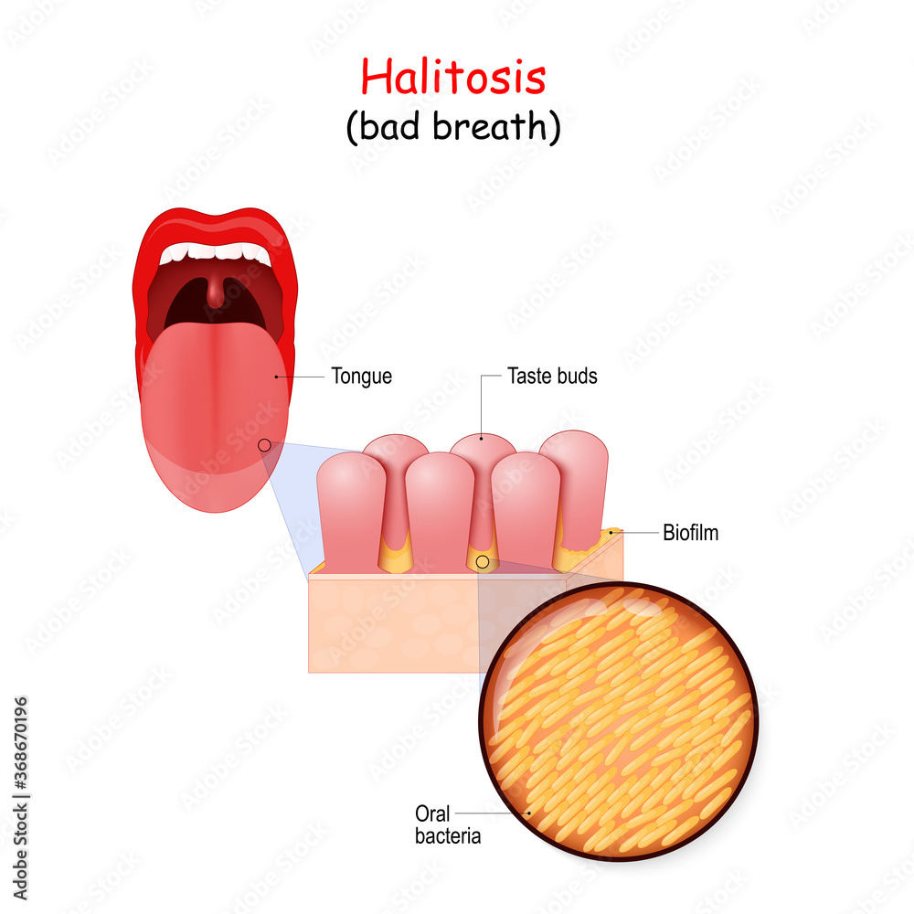 Halitoza - cum se formeaza respiratia urat mirositiare. Passionate Clinic. 